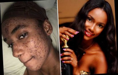 Model claims skincare line scarred her face so badly her career was ruined & she couldn’t leave the house