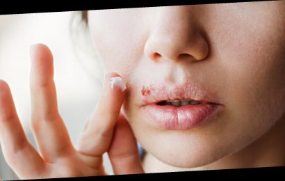 This Is The Best Way To Stop Cold Sores – The List