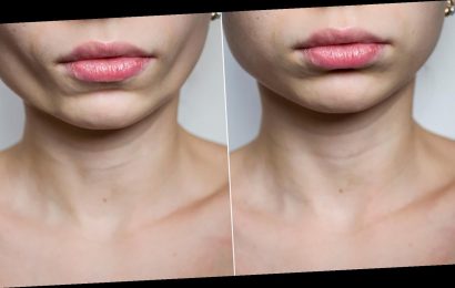 What You Need To Know About Buccal Fat Removal