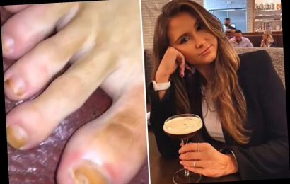 Woman horrified with fake tan fail as she ends up dyeing her toenails a gross shade of brown