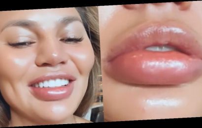 Chrissy Teigen Swears She Did Not Get Lip Fillers, Shows Off Her Swollen Lip From an Allergic Reaction