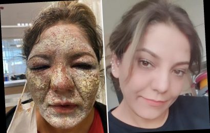 Woman left with horrific facial burns and oozing pus after botched wrinkle treatment at Turkish clinic