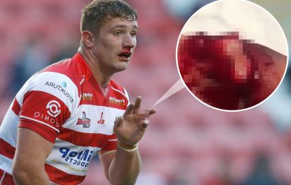 Rugby League star Nathan Mason shares horror video of bone popping out of bloodied finger after suffering sick injury