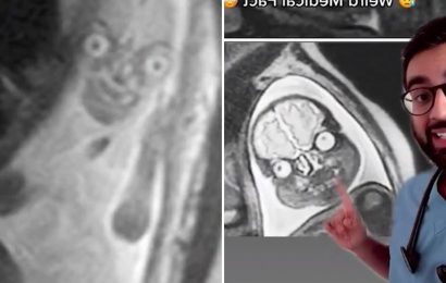 Doctor reveals 'creepy' reason pregnant women aren't shown MRI scans of their babies