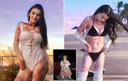 Woman with condition that causes skin sores flaunts them in sexy snaps