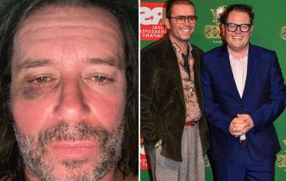 Alan Carr’s husband Paul Drayton apologises to him and says ‘he has not and would never hit me’ after black eye picture