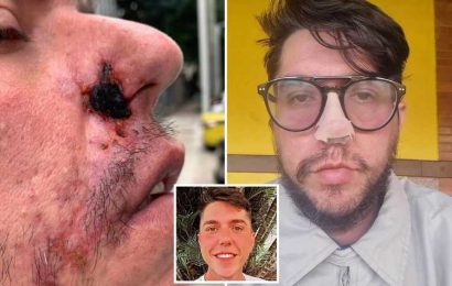 Horror of botched lip fillers laid bare as man loses huge chunk of his nose