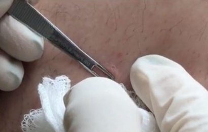 Dr Pimple Popper gets sprayed with pus as ‘banana pudding’ spot fights back