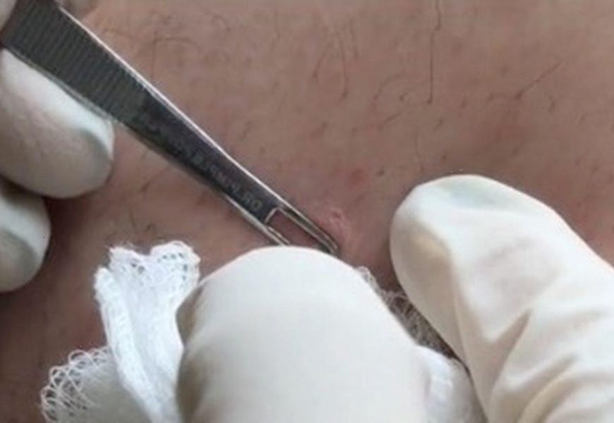 Dr Pimple Popper gets sprayed with pus as ‘banana pudding’ spot fights back