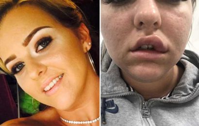 My lips exploded from infected fillers after practitioner told me to eat PINEAPPLE