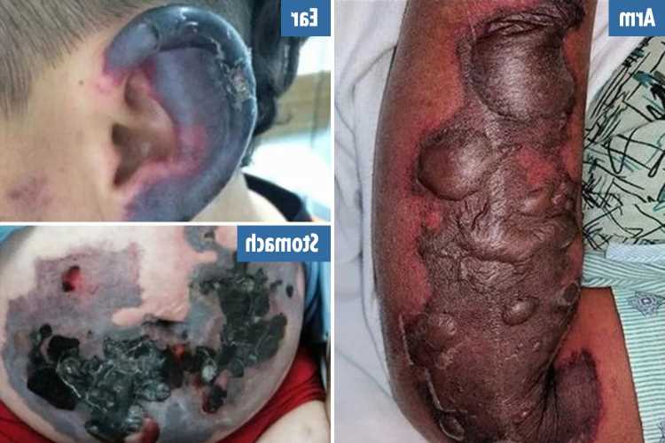 Grim photos reveal how cocaine can ROT skin and genitals as new drug crackdown launched – The Sun