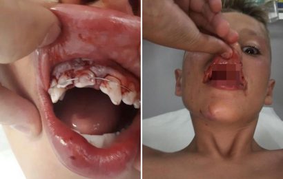Boy left with front teeth lodged in his NOSE after horrific waterslide accident on family holiday