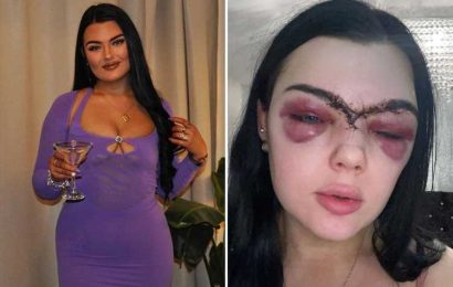 I split my forehead in HALF after tripping over – now my eyes are so swollen I look like a goldfish