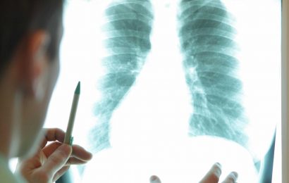 What can cause a lesion on the lung, are all lesions cancerous and how are they diagnosed and treated?