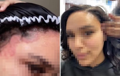 I spent $900 and 12 hours getting my hair done – 'it destroyed my scalp and I was left with burns all over my face'