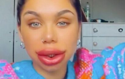 Woman left ‘looking like Dolmio puppet’ after getting lip fillers dissolved