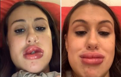 I got cheap lip filler and was left with awful blood blisters – I looked like a monster