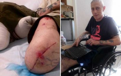 I was impaled on a metal fence for FIVE DAYS… I survived but lost both of my legs