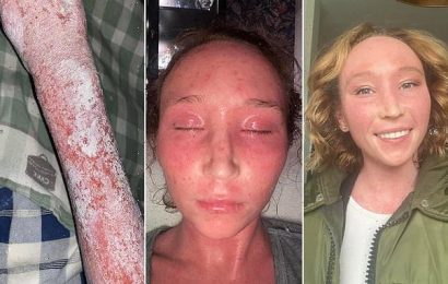 Woman shares ordeal after ditching dangerous eczema cream