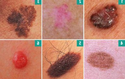 Can you spot the deadly moles from the harmless ones? The skin cancer signs you must never ignore – The Sun | The Sun
