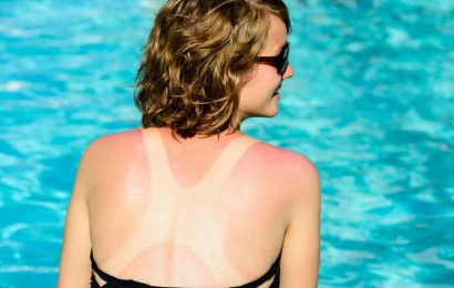 I’m a dermatologist – how to treat sunburn using a cheap kitchen essential | The Sun