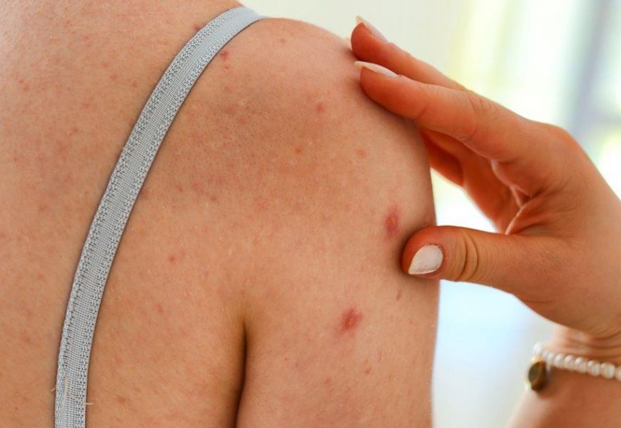 How to reduce body breakouts and bacne caused by the heatwave