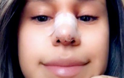 ‘My boyfriend cheated on me – so I made him pay for my nose job’