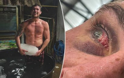 UFC star Darren Till shows off gruesome eye injury and hints he was given shiner by team-mate during sparring | The Sun