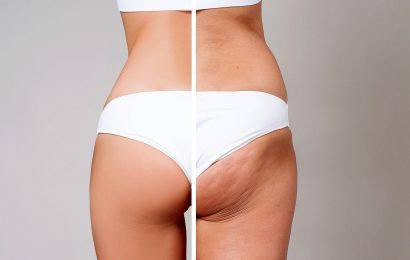 11 Best Cellulite Treatments for Women