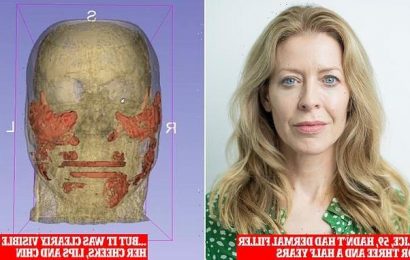&apos;20 years of filler stuck in my face&apos;: MRI reveals shocking truth
