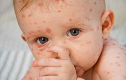 I'm a paramedic – here's the deadly chickenpox mistake all parents must know | The Sun