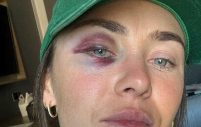 Women’s World Cup star Caitlin Foord shows off brutal black eye after ‘worst nightmare’ in loss | The Sun